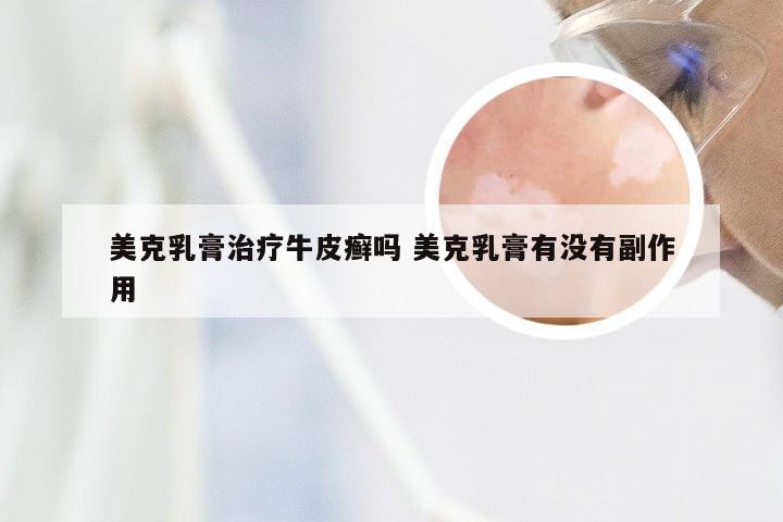 美克乳膏治疗牛皮癣吗 美克乳膏有没有副作用