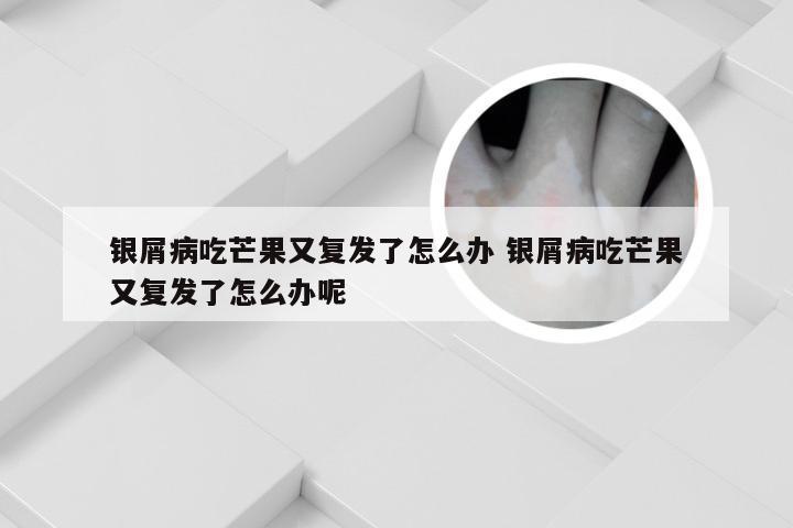 银屑病吃芒果又复发了怎么办 银屑病吃芒果又复发了怎么办呢