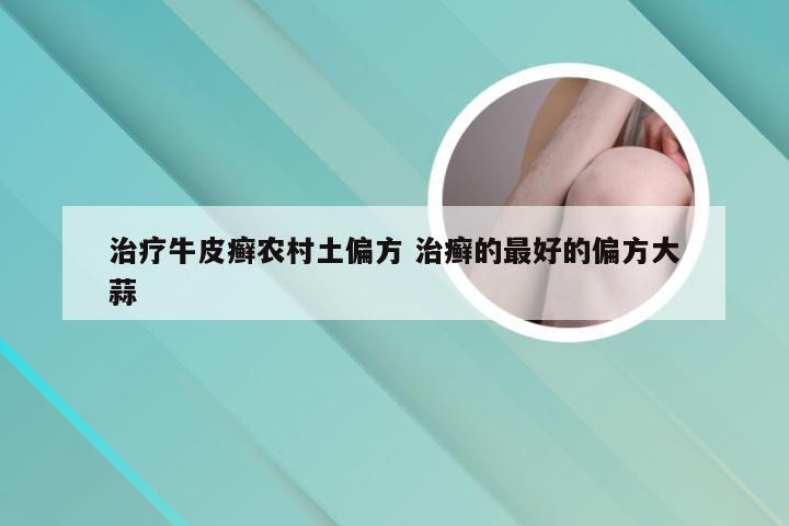 治疗牛皮癣农村土偏方 治癣的最好的偏方大蒜
