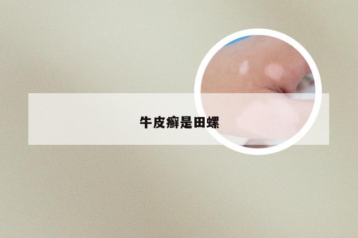 牛皮癣是田螺