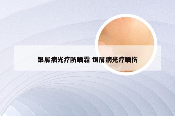 银屑病光疗防晒霜 银屑病光疗晒伤