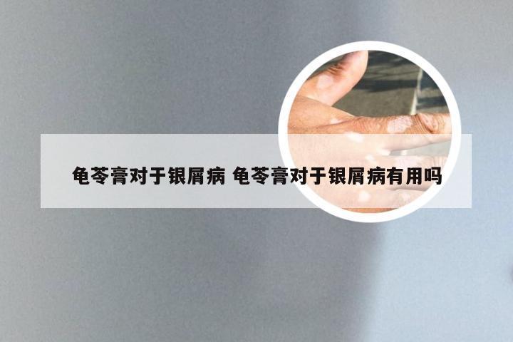 龟苓膏对于银屑病 龟苓膏对于银屑病有用吗