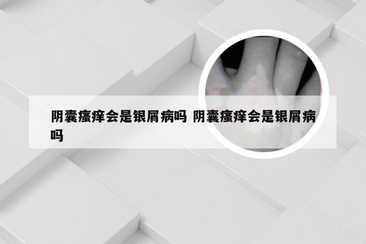 阴囊瘙痒会是银屑病吗 阴囊瘙痒会是银屑病吗