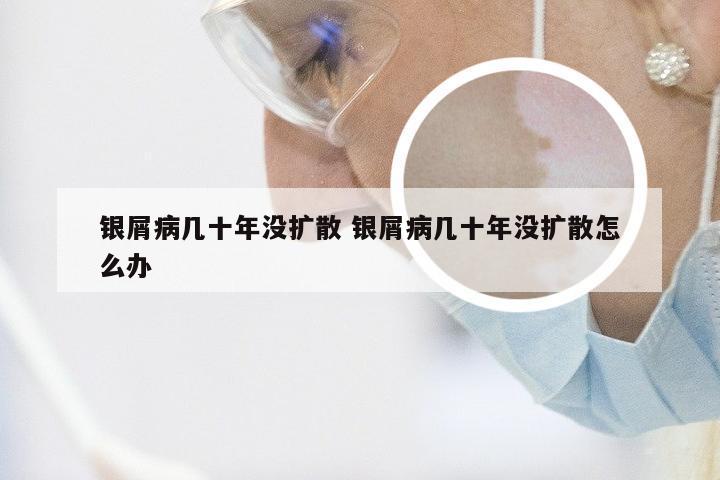 银屑病几十年没扩散 银屑病几十年没扩散怎么办