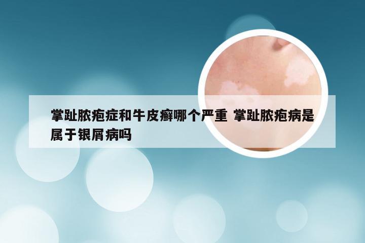 掌趾脓疱症和牛皮癣哪个严重 掌趾脓疱病是属于银屑病吗