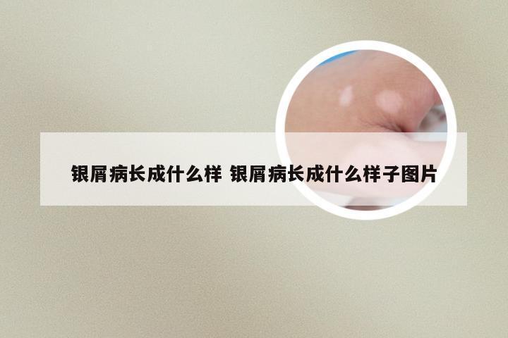 银屑病长成什么样 银屑病长成什么样子图片
