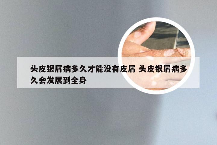 头皮银屑病多久才能没有皮屑 头皮银屑病多久会发展到全身