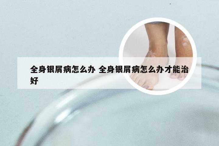 全身银屑病怎么办 全身银屑病怎么办才能治好