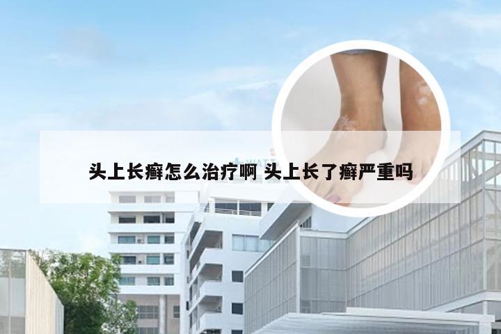 头上长癣怎么治疗啊 头上长了癣严重吗