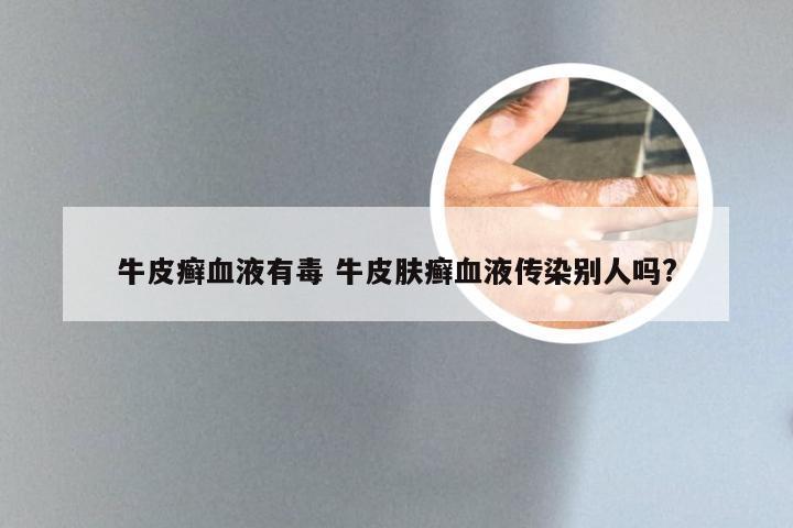 牛皮癣血液有毒 牛皮肤癣血液传染别人吗?