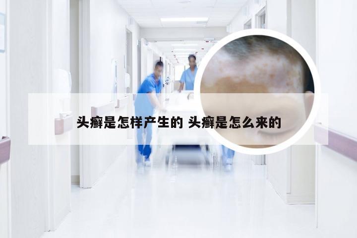 头癣是怎样产生的 头癣是怎么来的