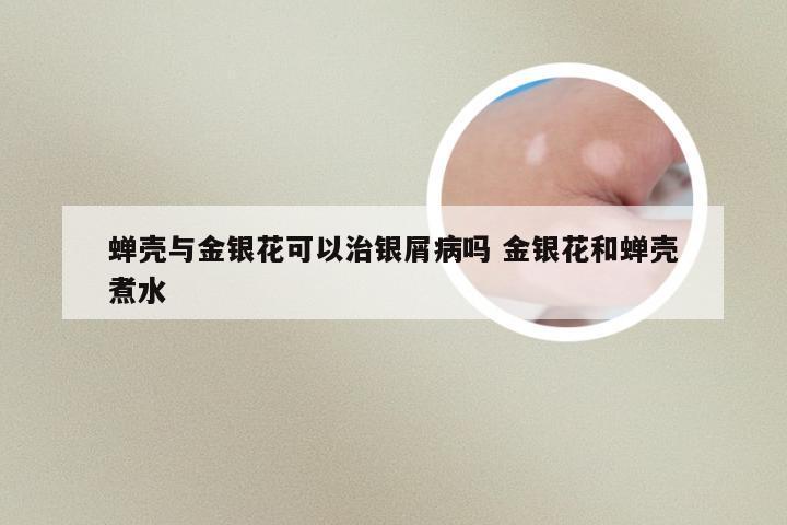 蝉壳与金银花可以治银屑病吗 金银花和蝉壳煮水