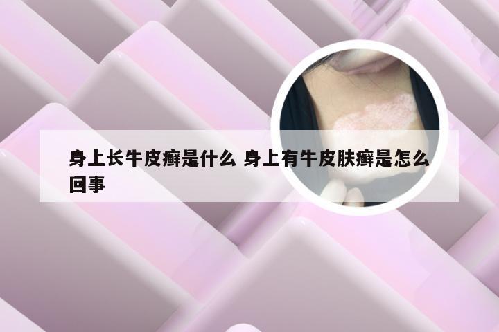 身上长牛皮癣是什么 身上有牛皮肤癣是怎么回事