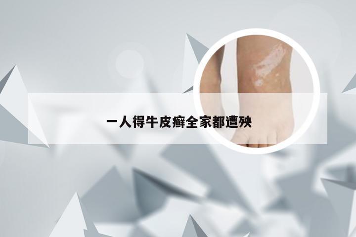 一人得牛皮癣全家都遭殃
