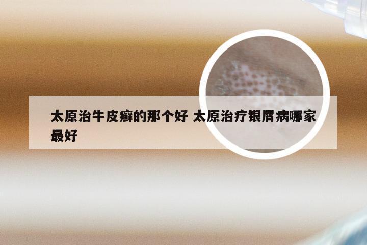 太原治牛皮癣的那个好 太原治疗银屑病哪家最好
