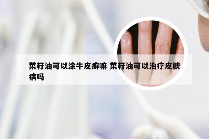 菜籽油可以涂牛皮癣嘛 菜籽油可以治疗皮肤病吗