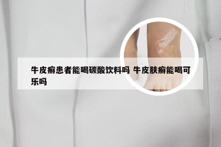 牛皮癣患者能喝碳酸饮料吗 牛皮肤癣能喝可乐吗