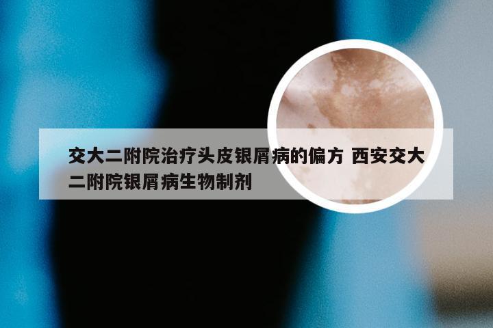 交大二附院治疗头皮银屑病的偏方 西安交大二附院银屑病生物制剂