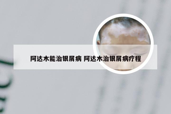 阿达木能治银屑病 阿达木治银屑病疗程