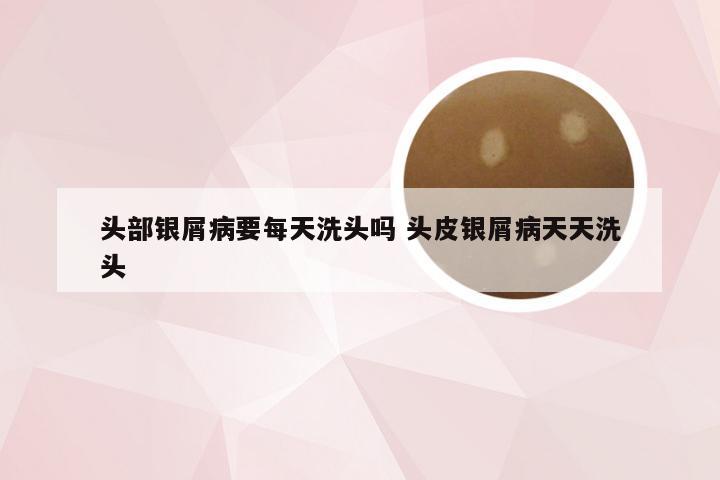 头部银屑病要每天洗头吗 头皮银屑病天天洗头