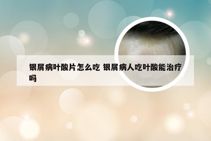 银屑病叶酸片怎么吃 银屑病人吃叶酸能治疗吗