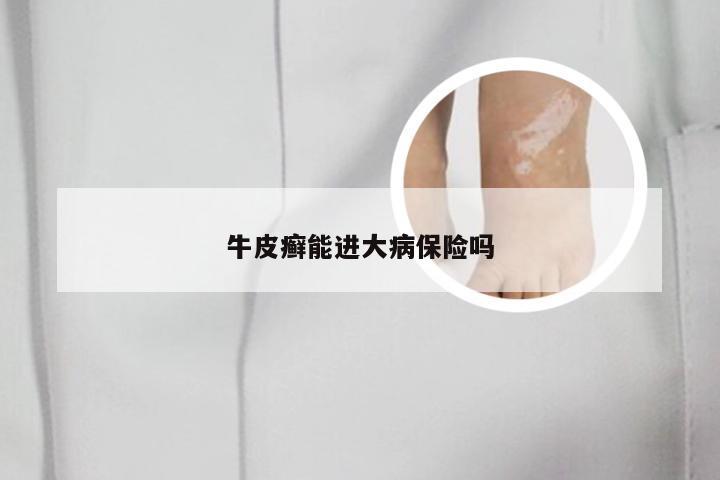 牛皮癣能进大病保险吗