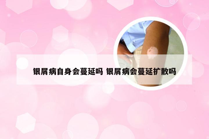 银屑病自身会蔓延吗 银屑病会蔓延扩散吗