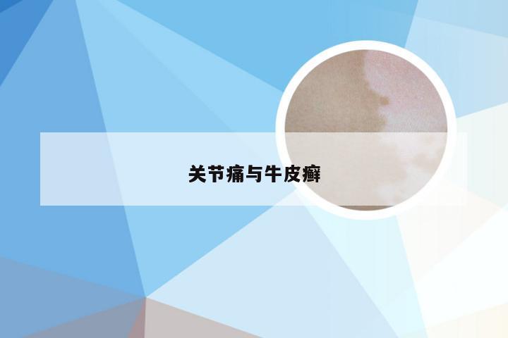 关节痛与牛皮癣