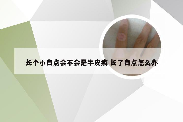 长个小白点会不会是牛皮癣 长了白点怎么办