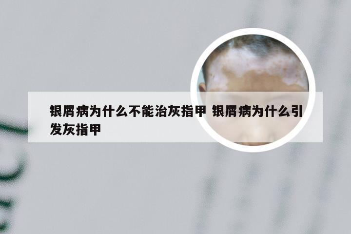 银屑病为什么不能治灰指甲 银屑病为什么引发灰指甲