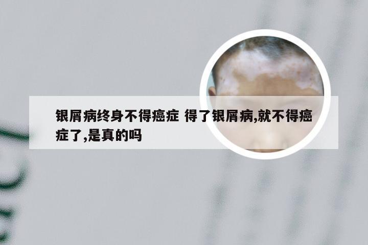 银屑病终身不得癌症 得了银屑病,就不得癌症了,是真的吗
