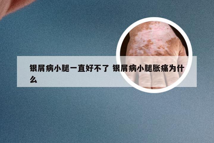 银屑病小腿一直好不了 银屑病小腿胀痛为什么