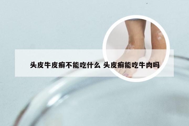 头皮牛皮癣不能吃什么 头皮癣能吃牛肉吗