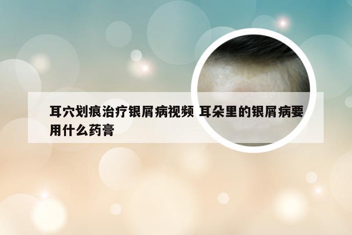 耳穴划痕治疗银屑病视频 耳朵里的银屑病要用什么药膏
