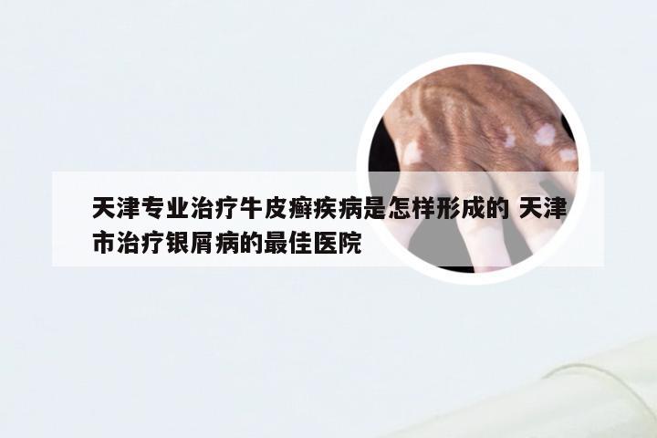 天津专业治疗牛皮癣疾病是怎样形成的 天津市治疗银屑病的最佳医院