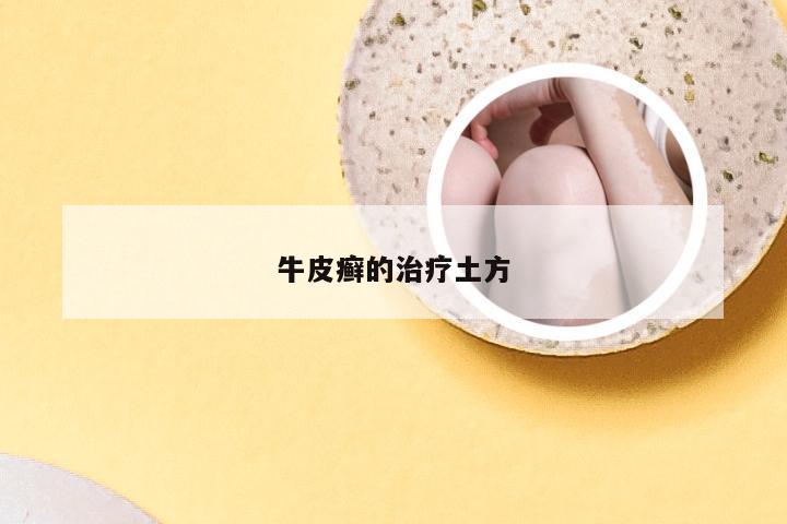 牛皮癣的治疗土方