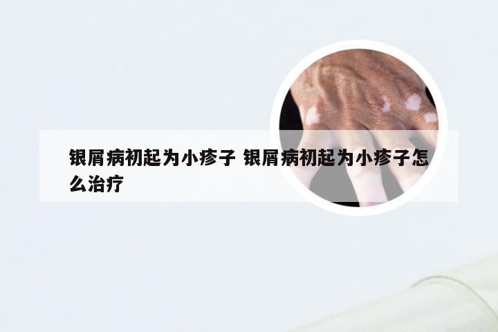 银屑病初起为小疹子 银屑病初起为小疹子怎么治疗