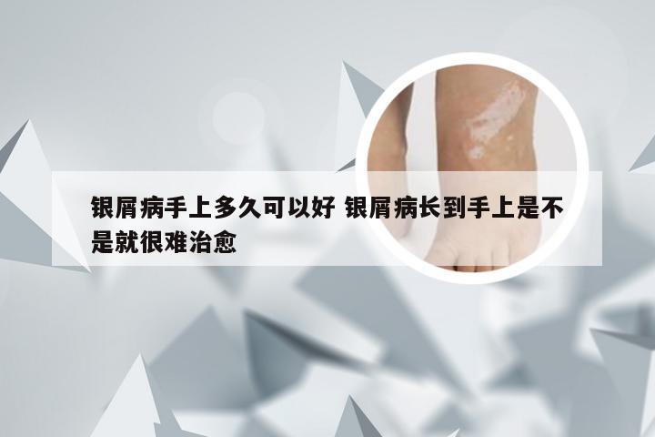 银屑病手上多久可以好 银屑病长到手上是不是就很难治愈