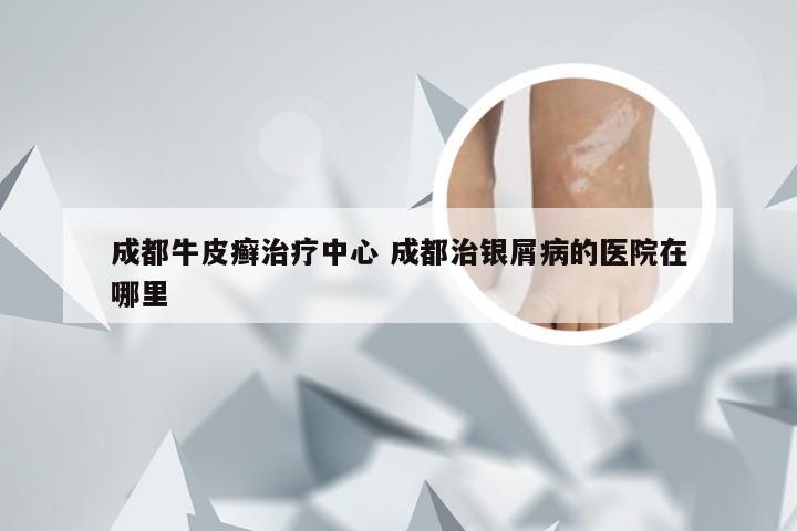 成都牛皮癣治疗中心 成都治银屑病的医院在哪里