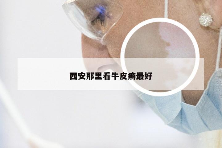 西安那里看牛皮癣最好