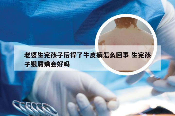 老婆生完孩子后得了牛皮癣怎么回事 生完孩子银屑病会好吗