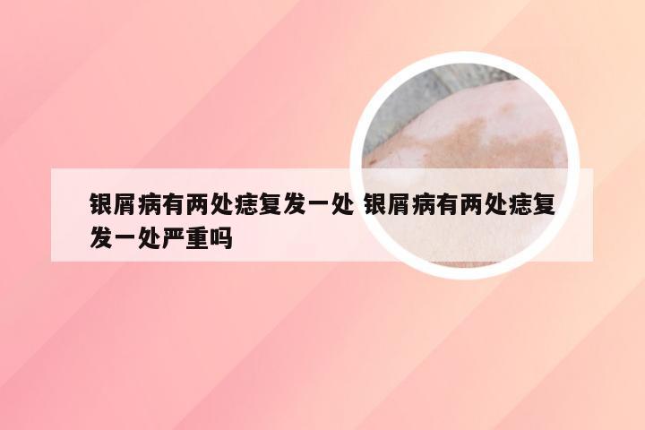 银屑病有两处痣复发一处 银屑病有两处痣复发一处严重吗