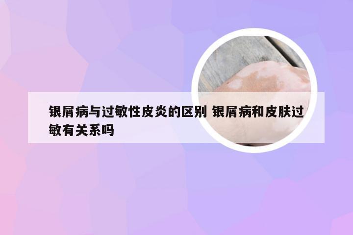 银屑病与过敏性皮炎的区别 银屑病和皮肤过敏有关系吗