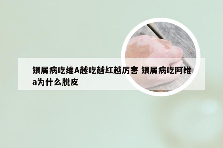 银屑病吃维A越吃越红越厉害 银屑病吃阿维a为什么脱皮
