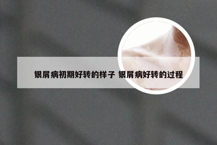 银屑病初期好转的样子 银屑病好转的过程