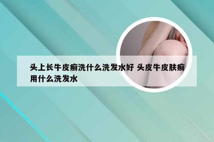 头上长牛皮癣洗什么洗发水好 头皮牛皮肤癣用什么洗发水