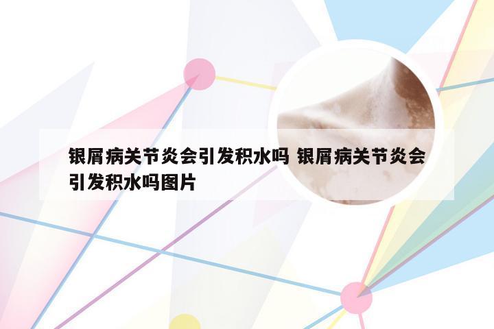 银屑病关节炎会引发积水吗 银屑病关节炎会引发积水吗图片