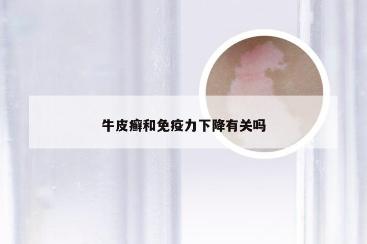 牛皮癣和免疫力下降有关吗