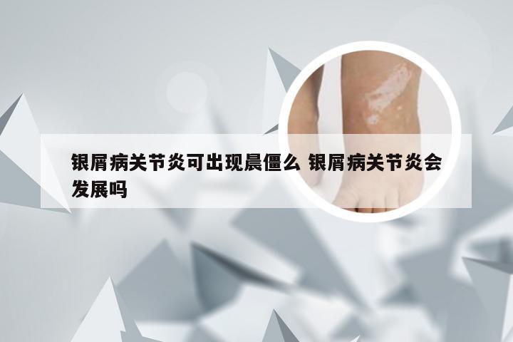 银屑病关节炎可出现晨僵么 银屑病关节炎会发展吗