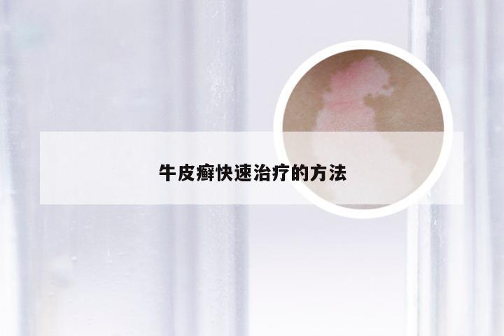 牛皮癣快速治疗的方法